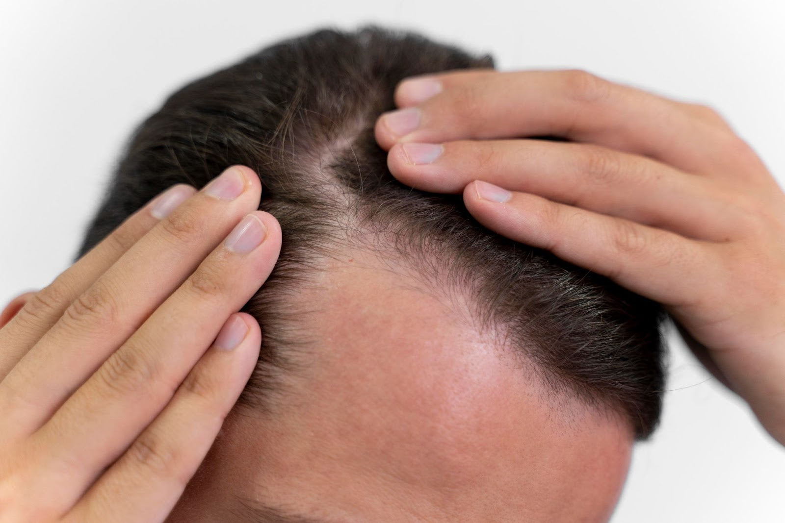 Hair Thinning problem