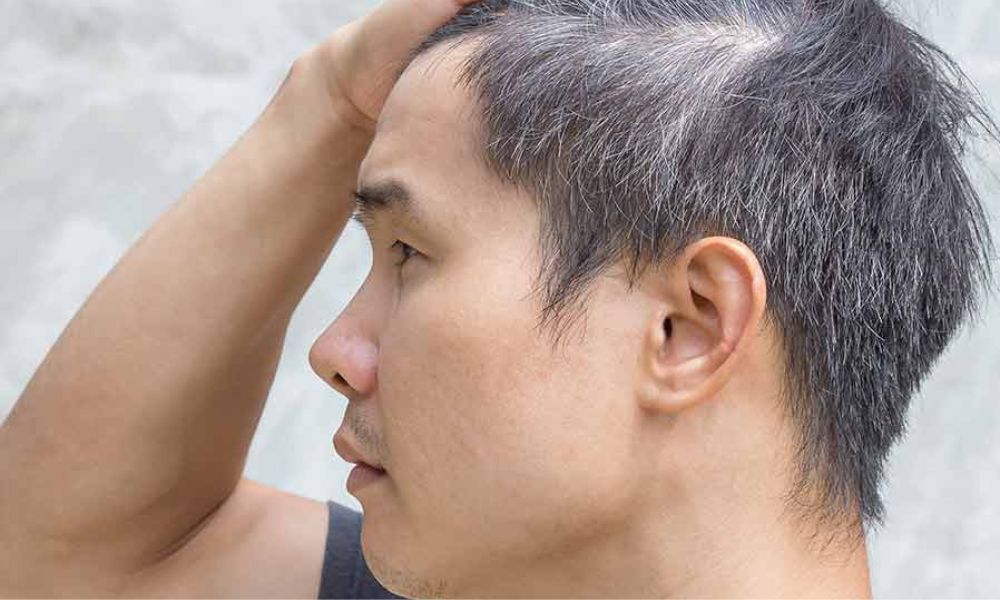 What Causes White Hair at Early Age