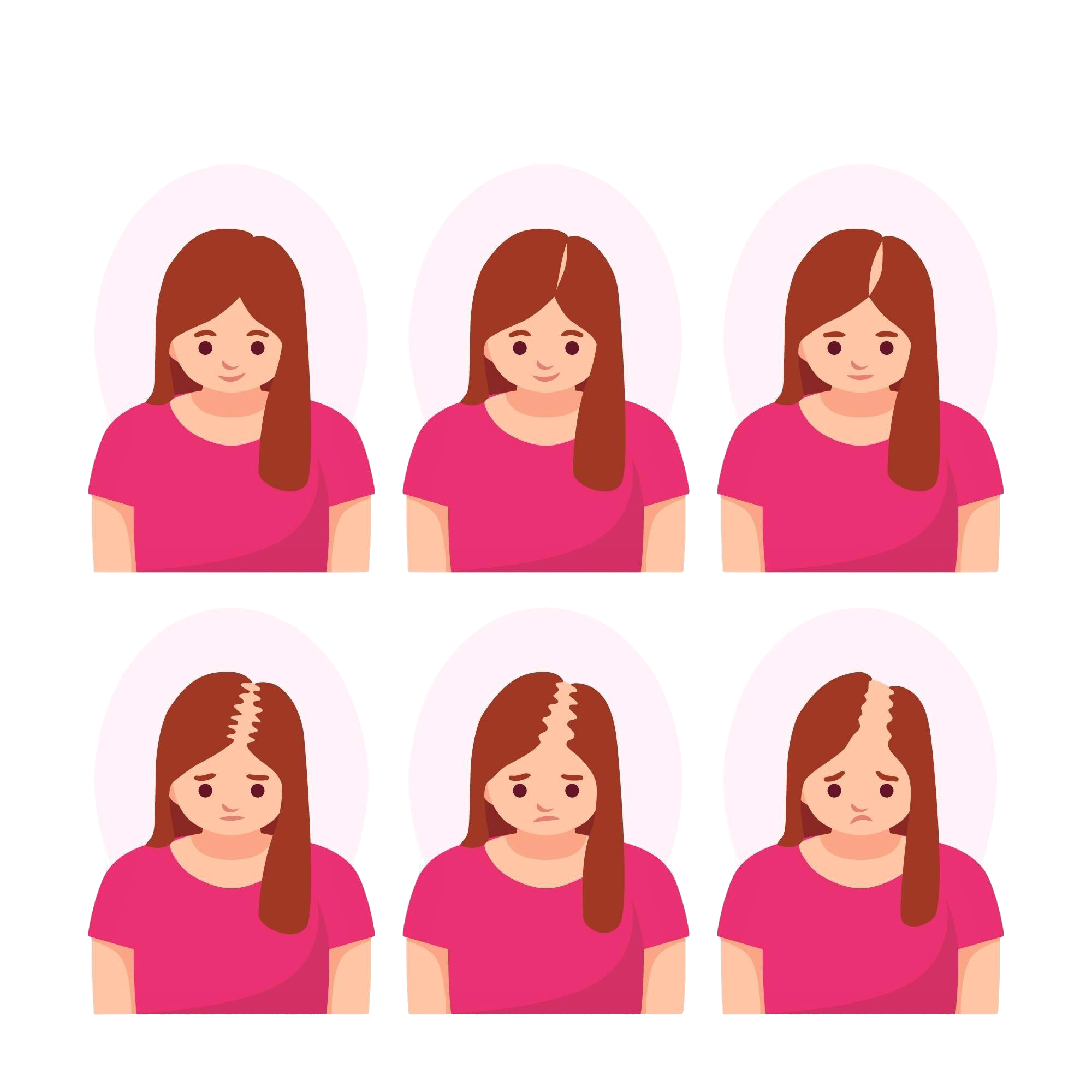 Female Baldness Pattern