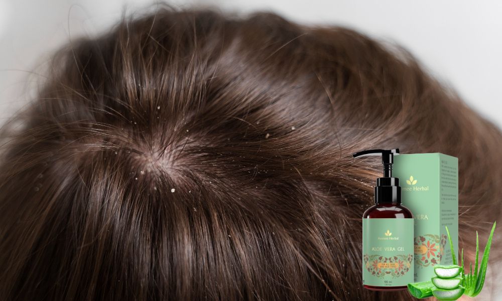 Itchy Scalp, Reduce Dandruff: How to Use Aloe Vera for Hair
