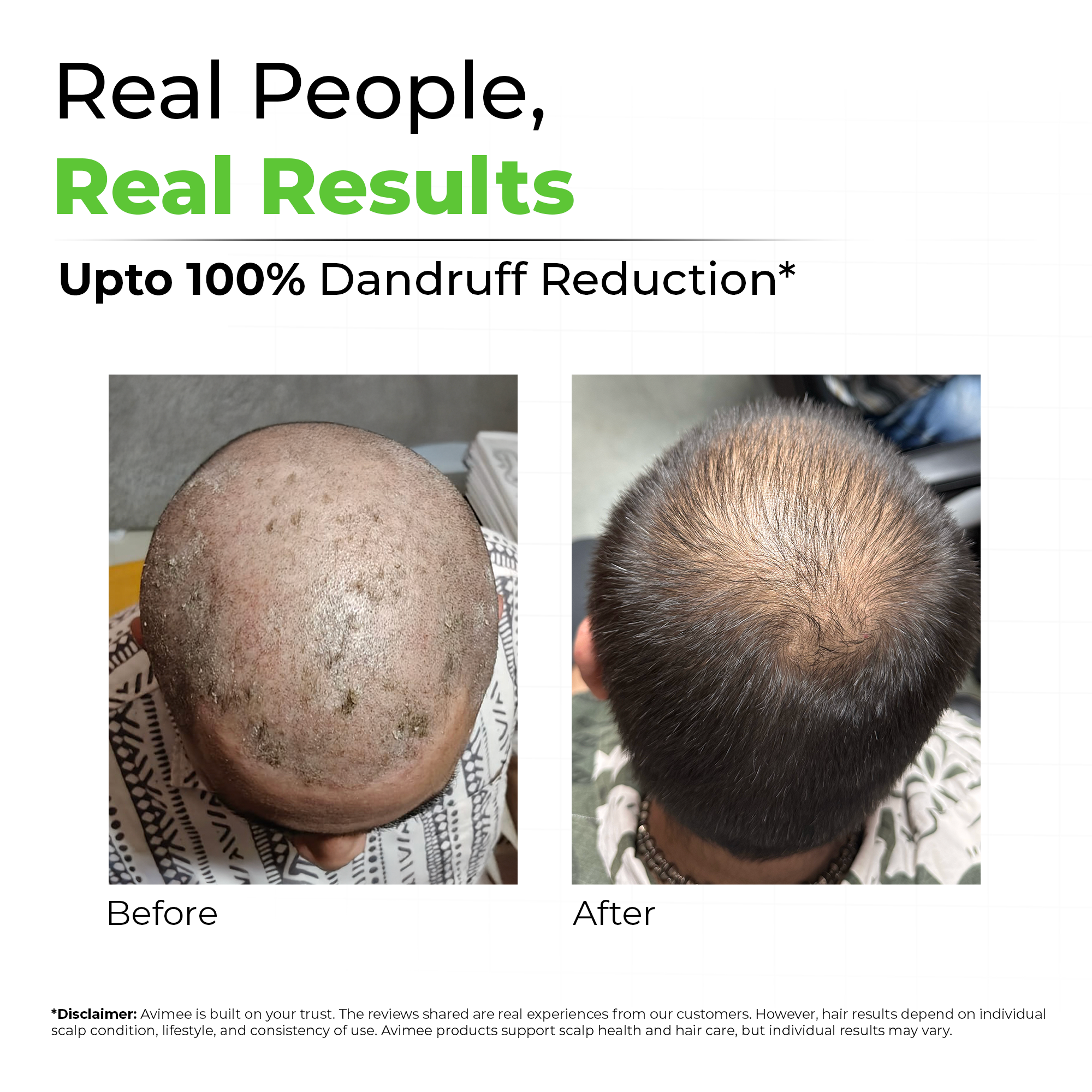 Shakuntala Hair Cleanser for Dandruff