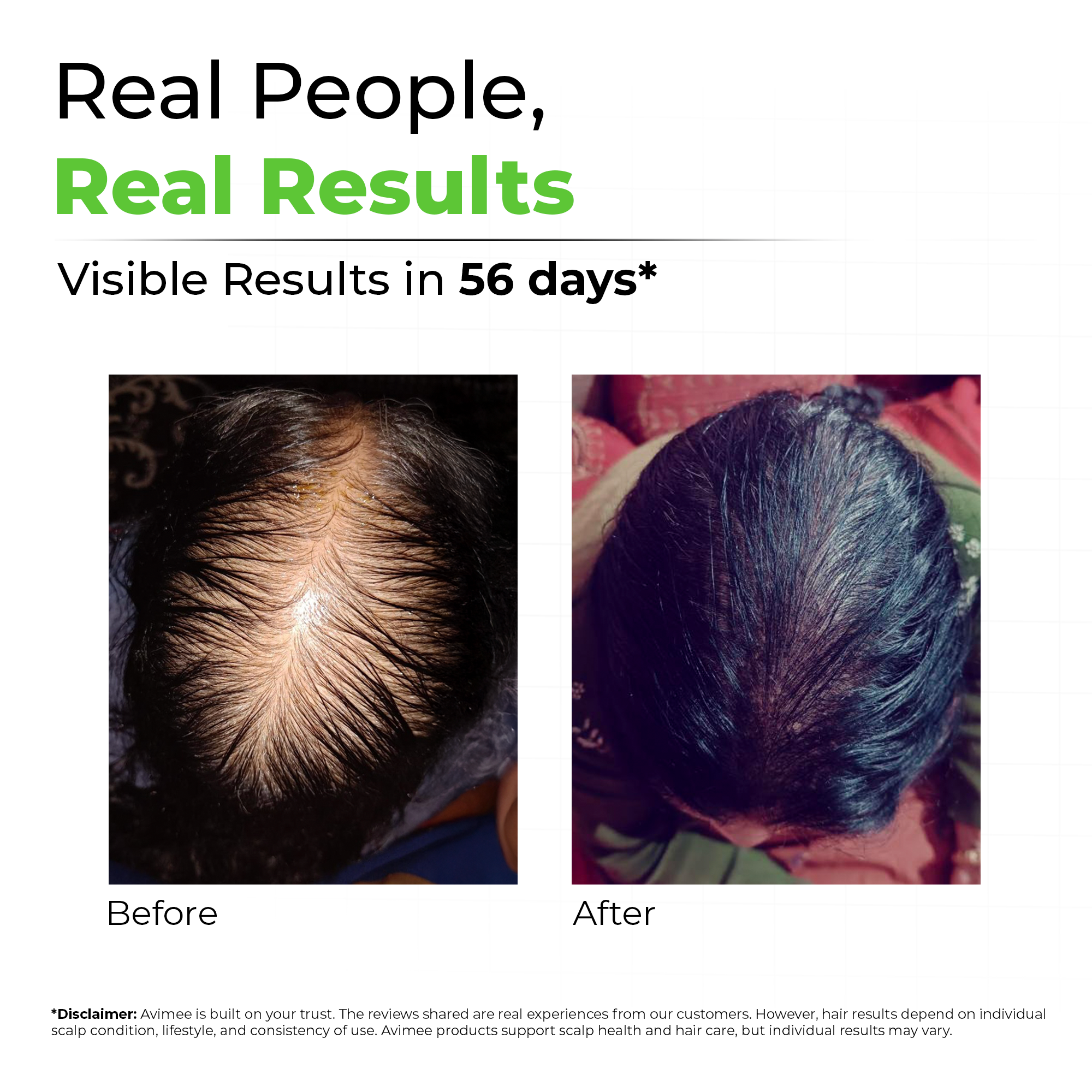 Scalptone Hair Growth Serum with 5% Nansyl & Pea Sprout Extract