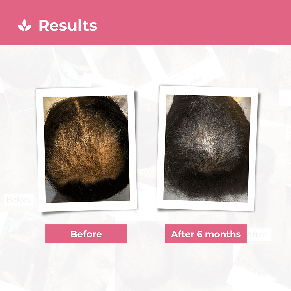 Hair Growth Kit for Stage 3 Hair Loss