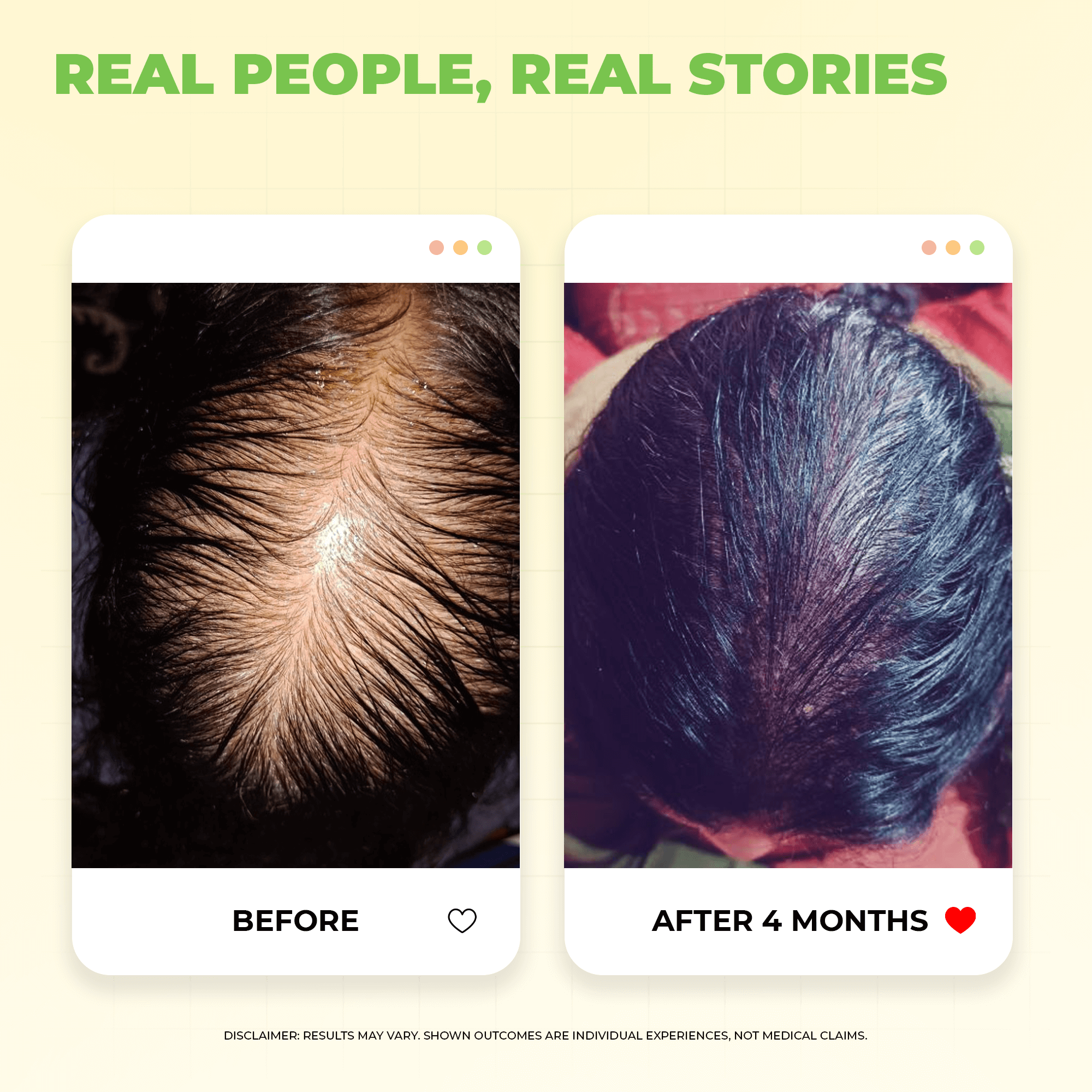 Scalptone Hair Growth Serum with 5% Nansyl & Pea Sprout Extract