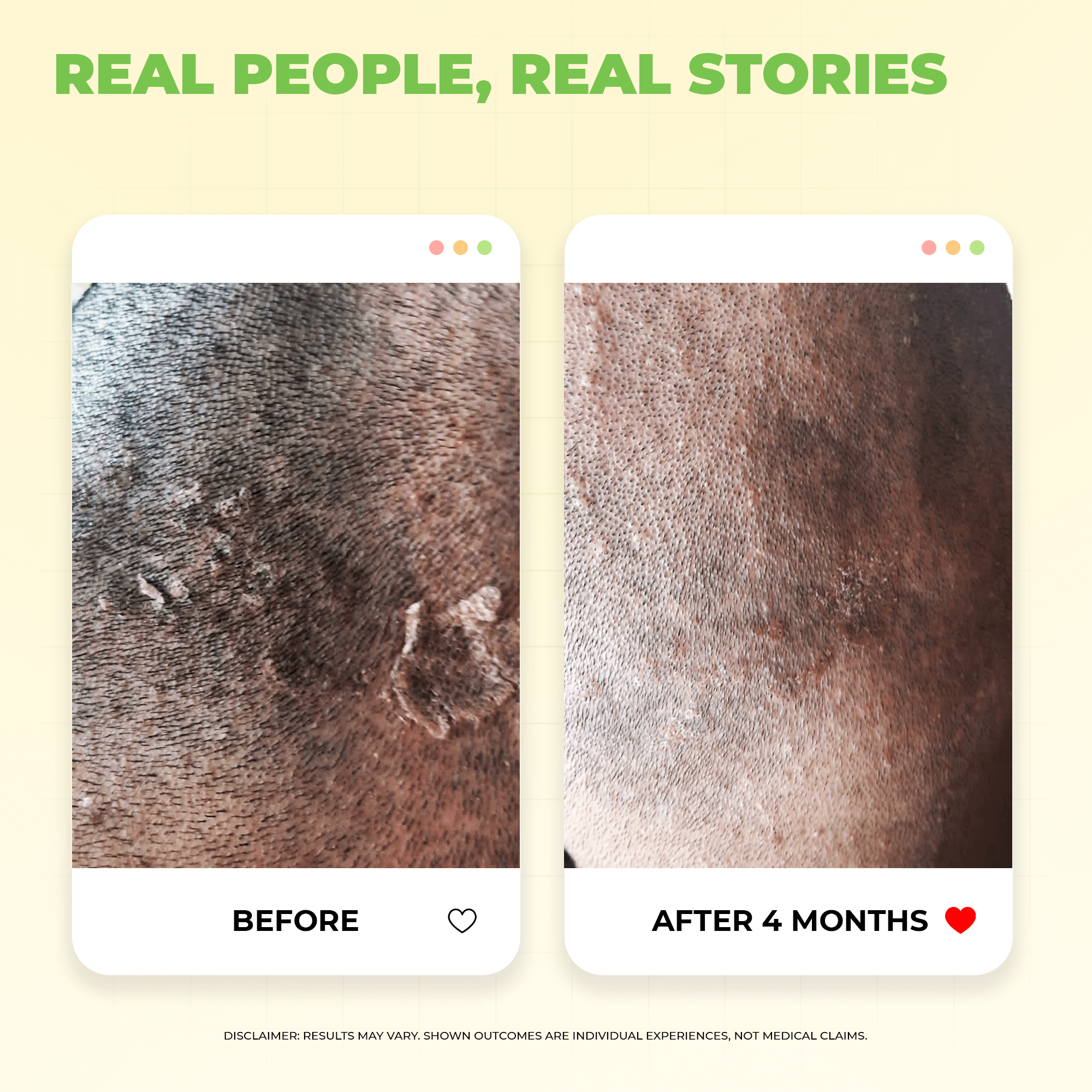 Shakuntala Hair Cleanser for Dandruff