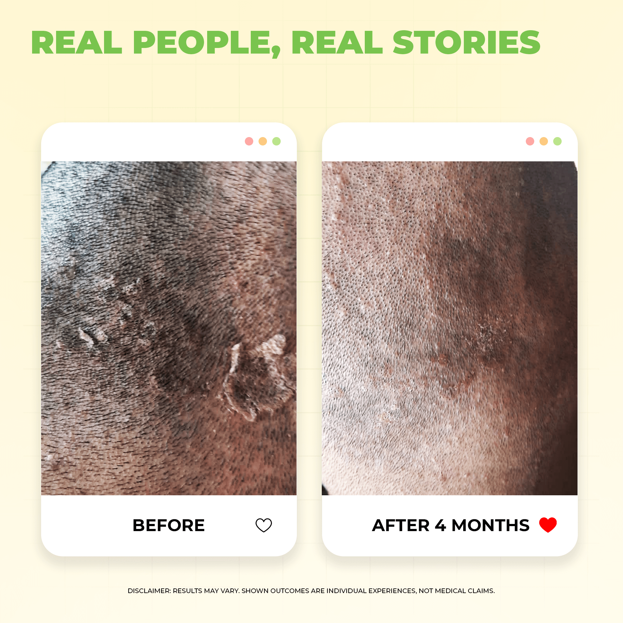 Scalptone Dandruff Serum