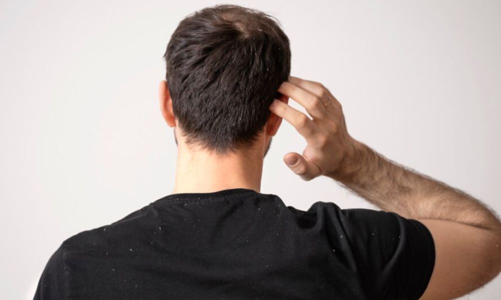 Can Dandruff And Itchy Scalp Cause Hair Loss