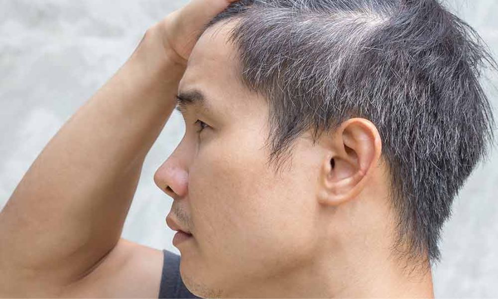 What Causes White Hair at Early Age 