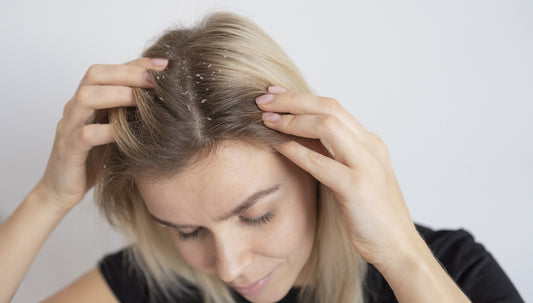 young woman showing Dandruff in her scalp 