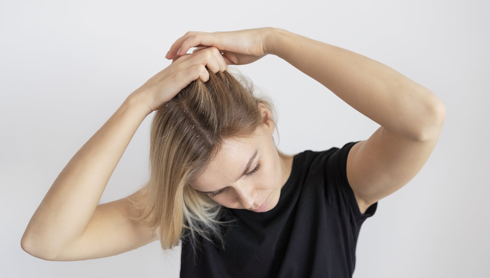 Woman showing Dandruff and Itchy Scalp