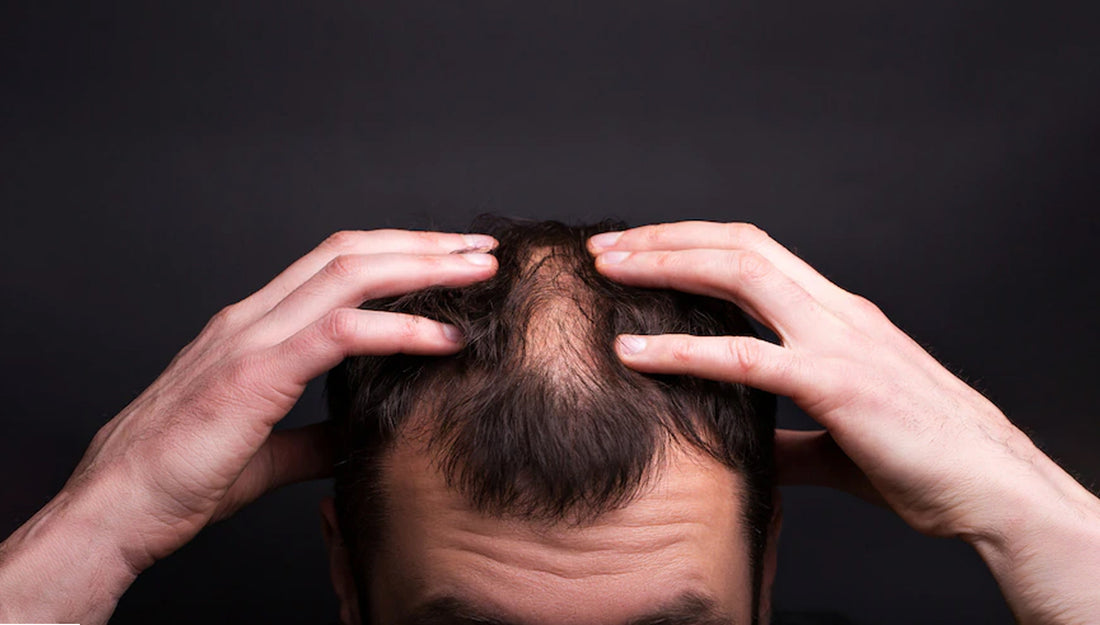 Man is showing hair fall in his head