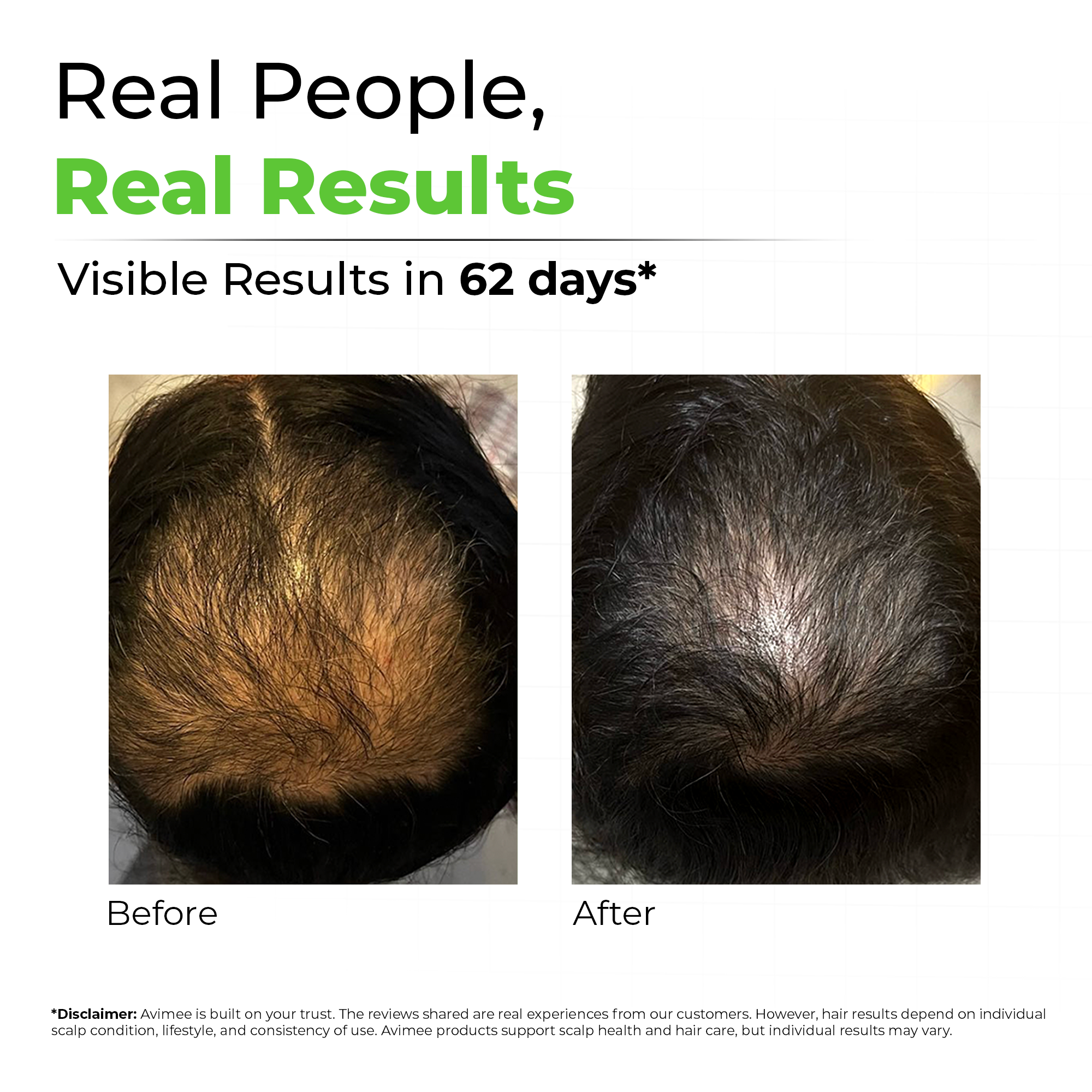 Hair Growth Kit for Stage 3 Hair Loss