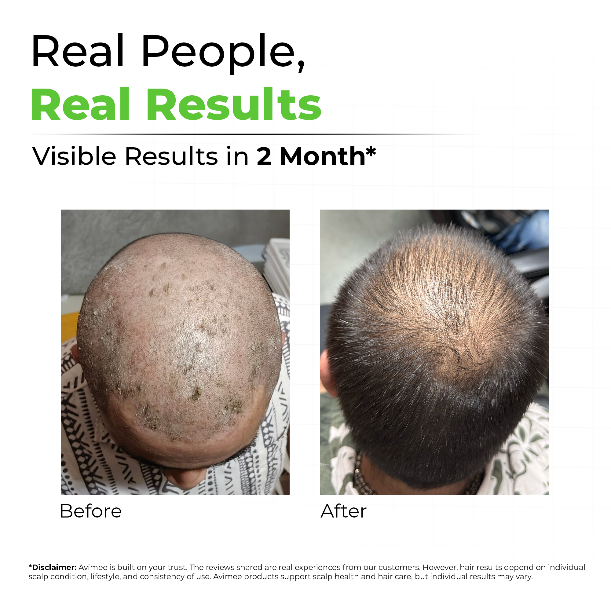 Scalptone Dandruff Serum