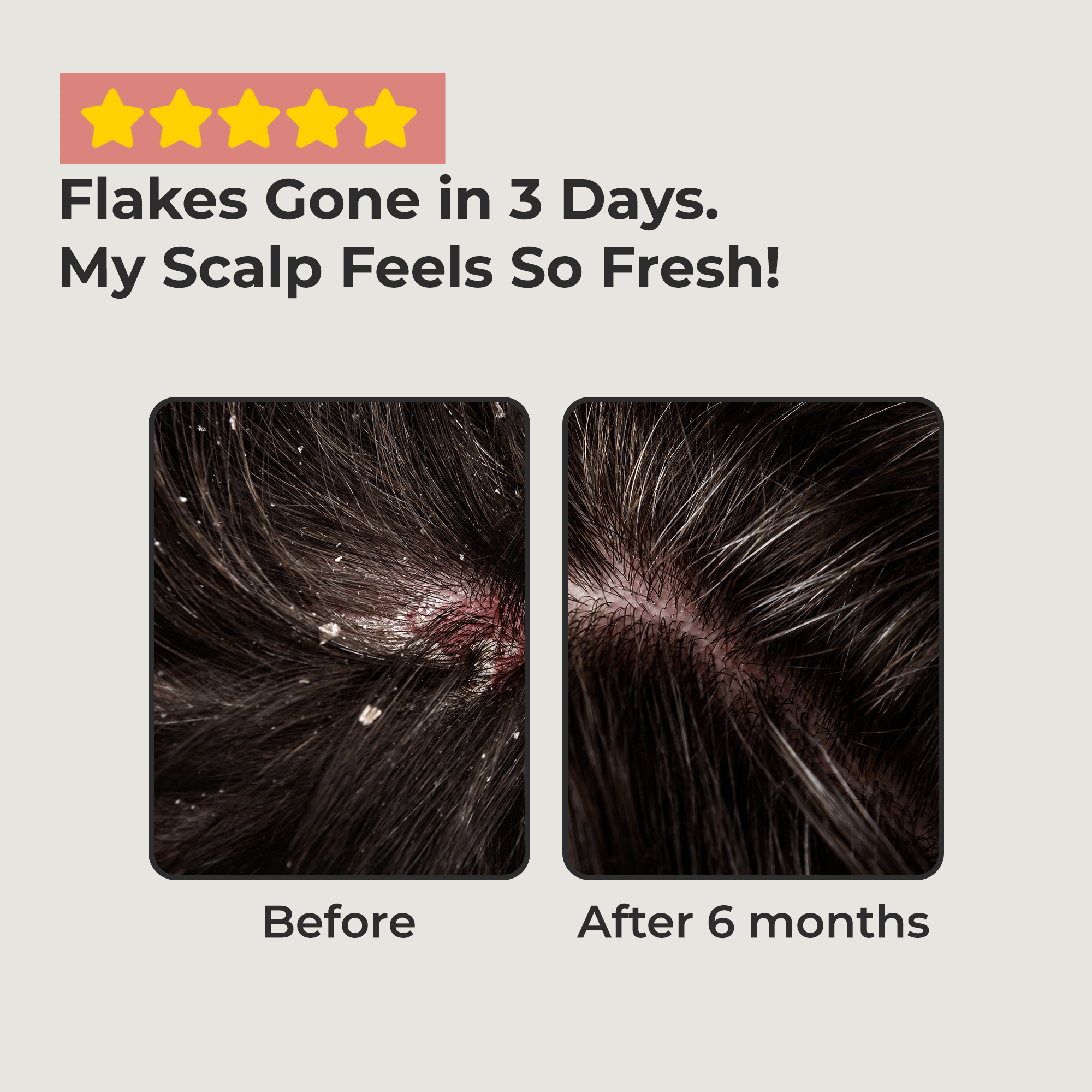 Scalptone Dandruff Serum