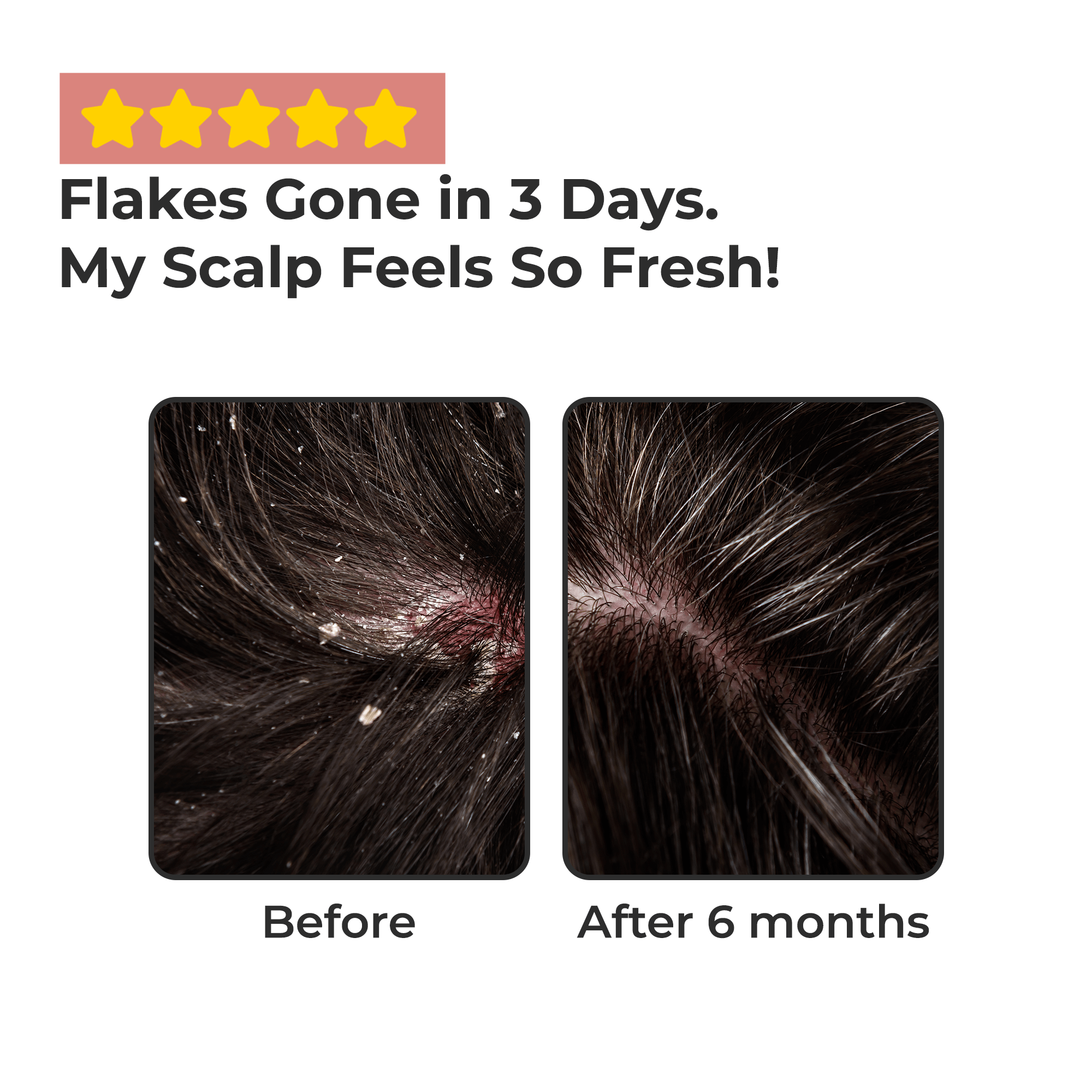 Scalptone Dandruff Serum